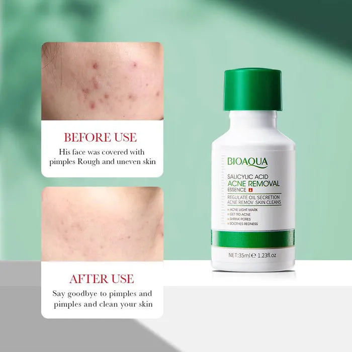 BIOAQUA Salicylic Acid Acne Removal Essence Serum - 35ml
