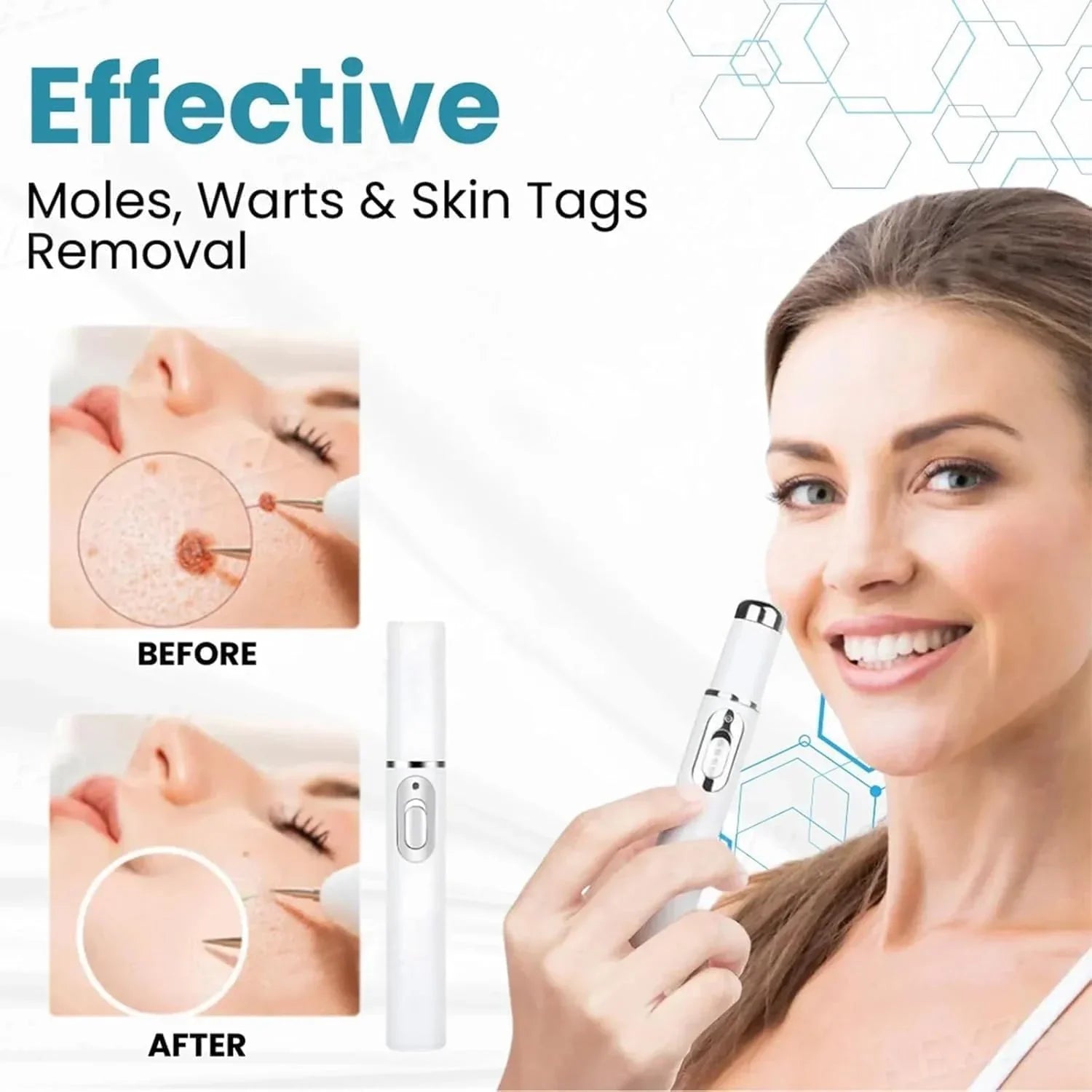Non-Invasive Mole and Wart Removal Pen