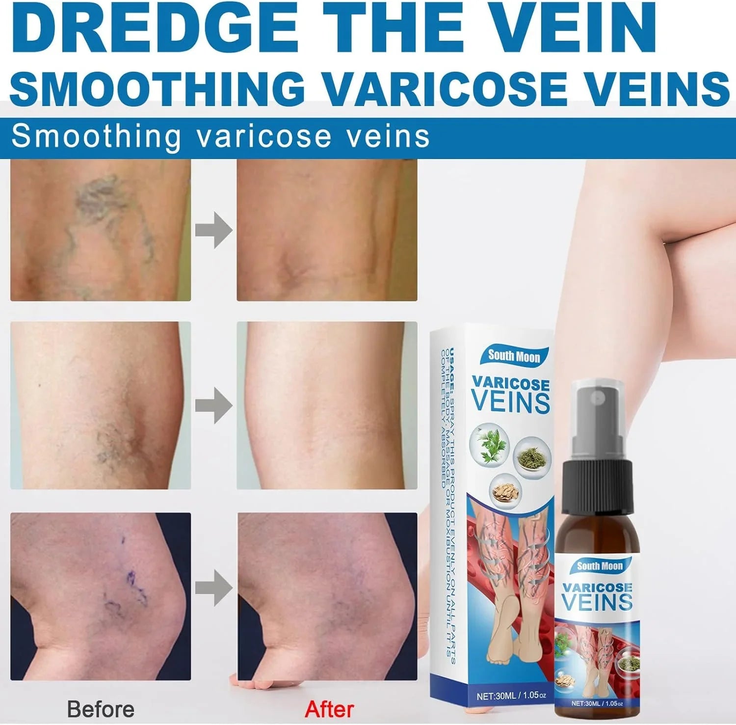 South Moon Vein Healing Varicose Veins Treatment Spray - 30ml